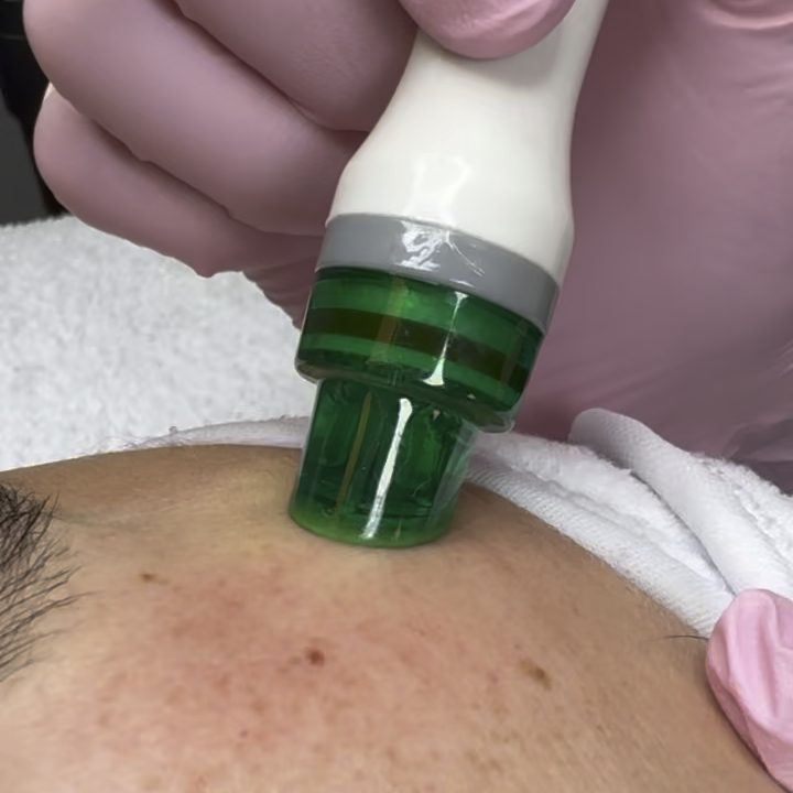 Facials – Aquafacial